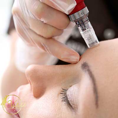 Microneedline