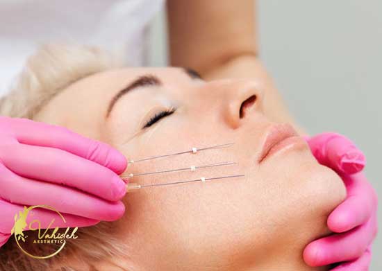 Mono-Collagen-thread Mono-Collagen-thread