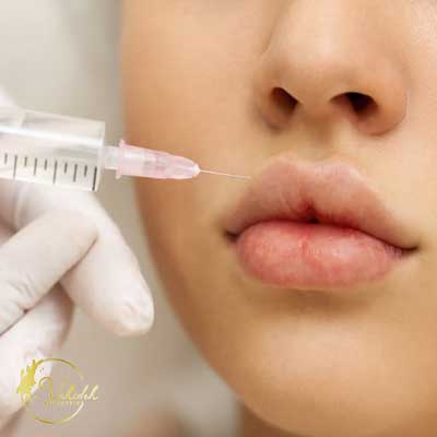 dissolving filler