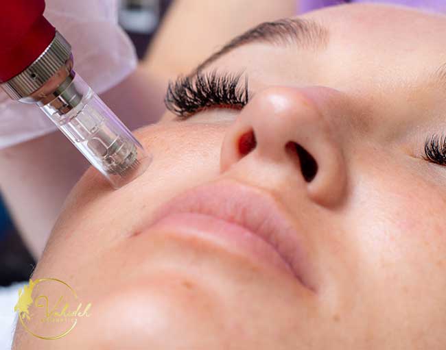 Microneedline Microneedline