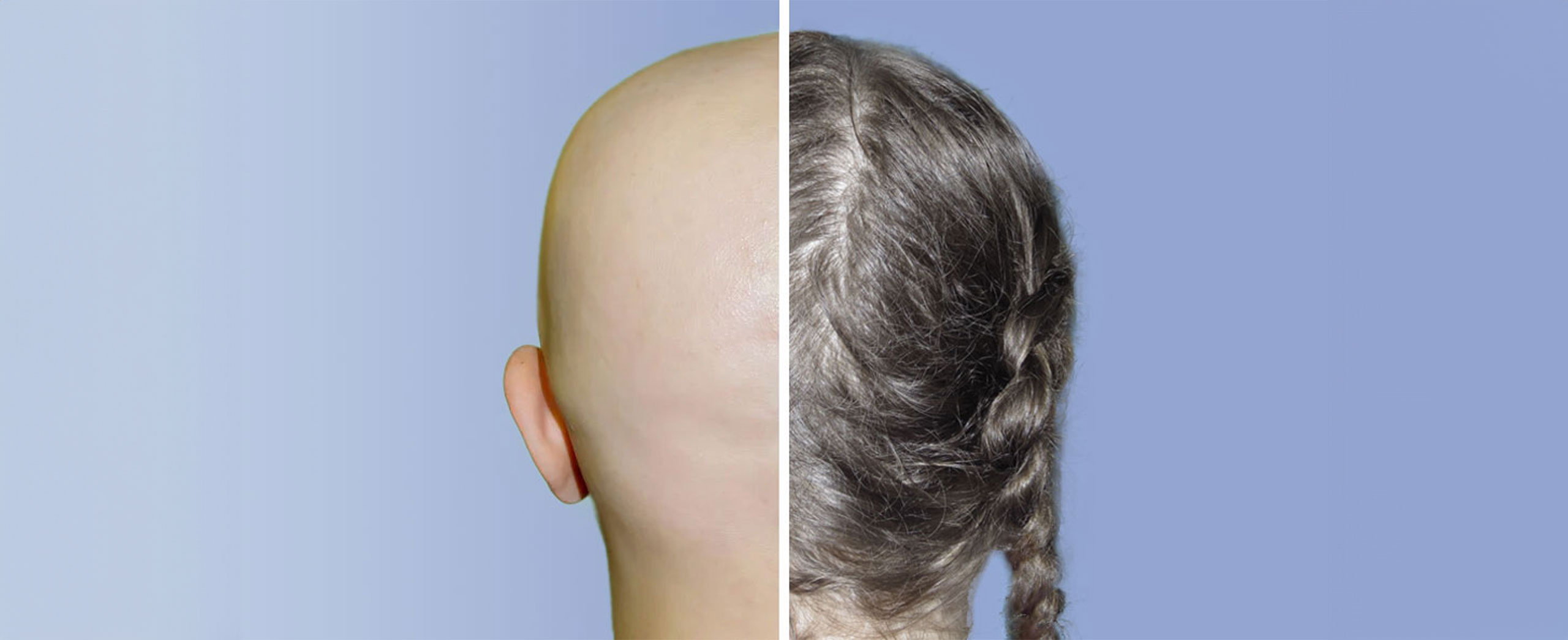Hair Loss Treatments