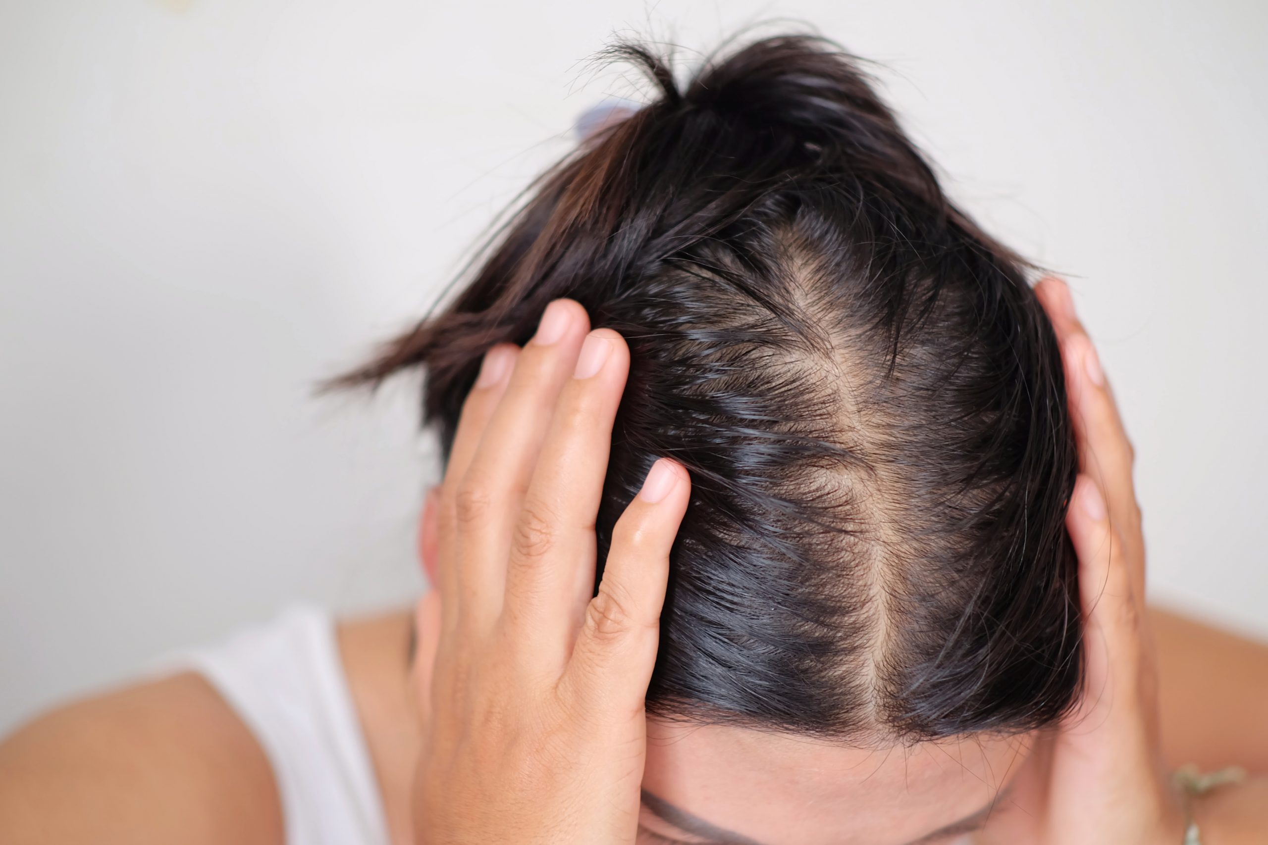 Hair Loss Treatments